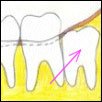 the impacted wisdom tooth